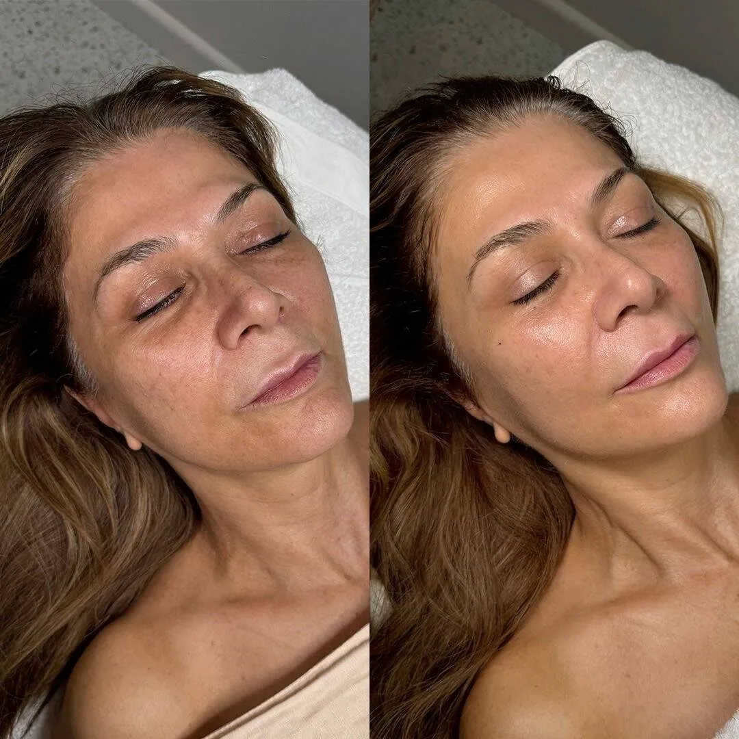 Skin before and after a facial at MelaBody
