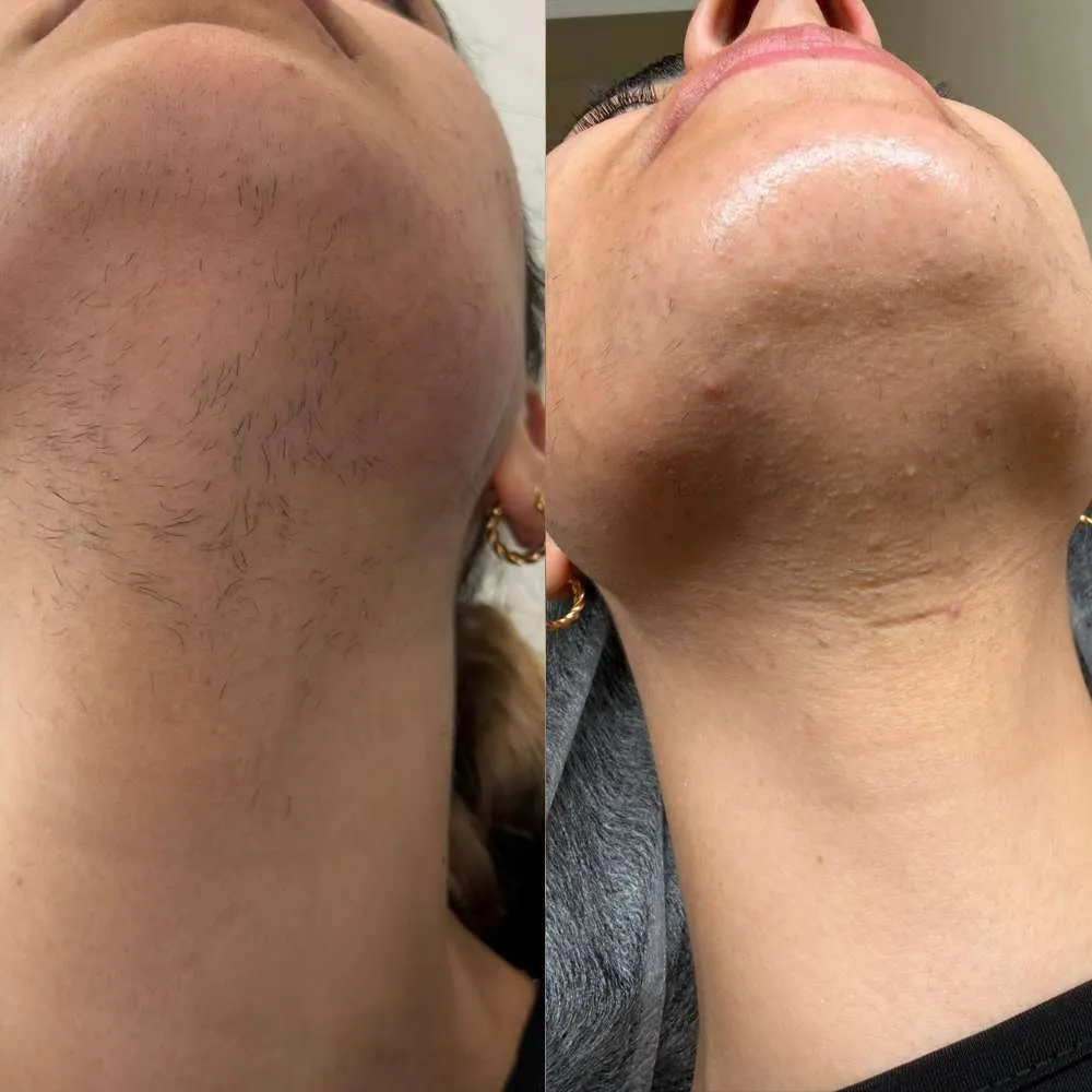 Chin and jawline before and after electrolysis at MelaBody
